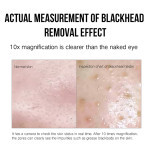 Facial Blackhead Remover